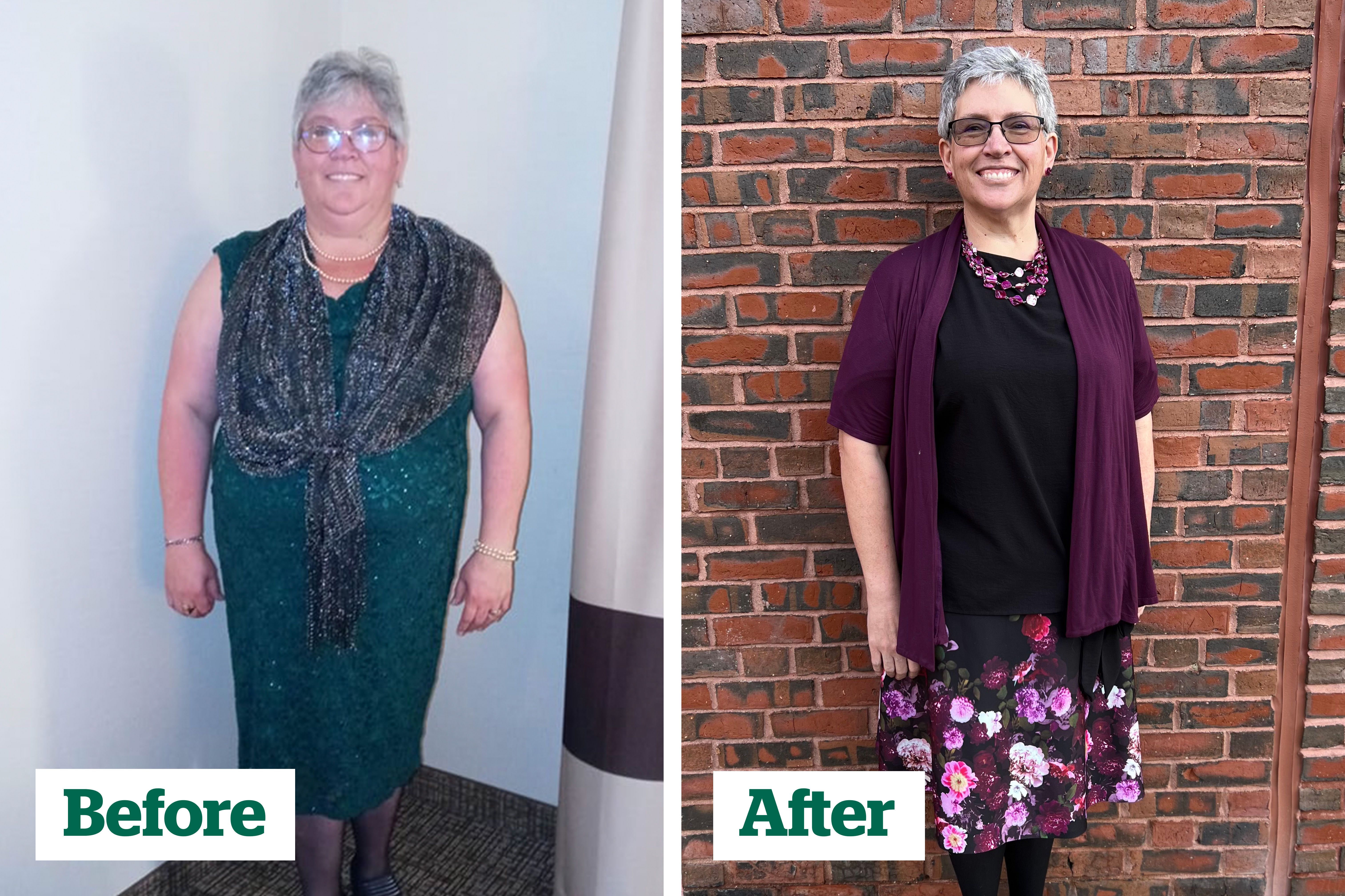 Before and after patient Tanya Brown had bariatric weight loss surgery