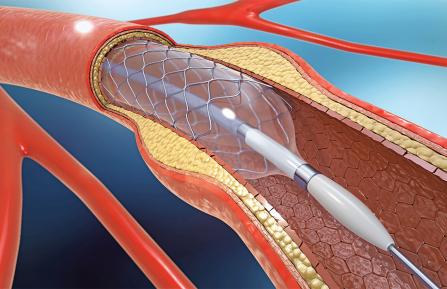 Diagram of a stent installation